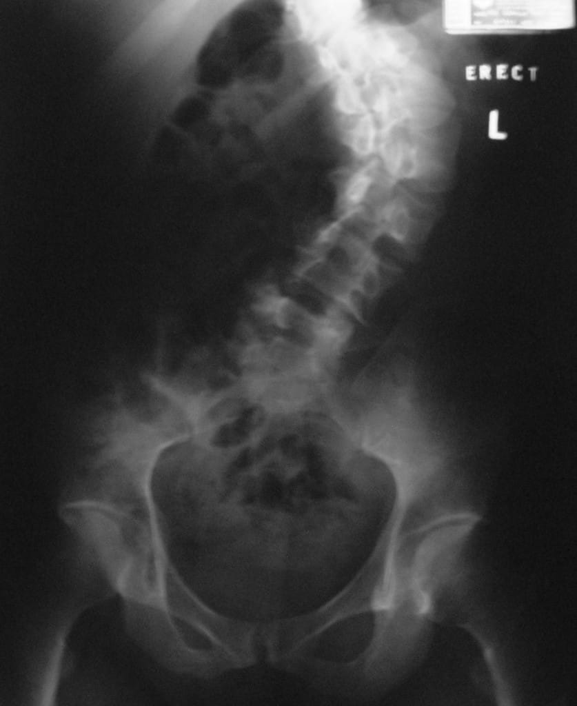 x-ray of scoliosis or curved spine full length