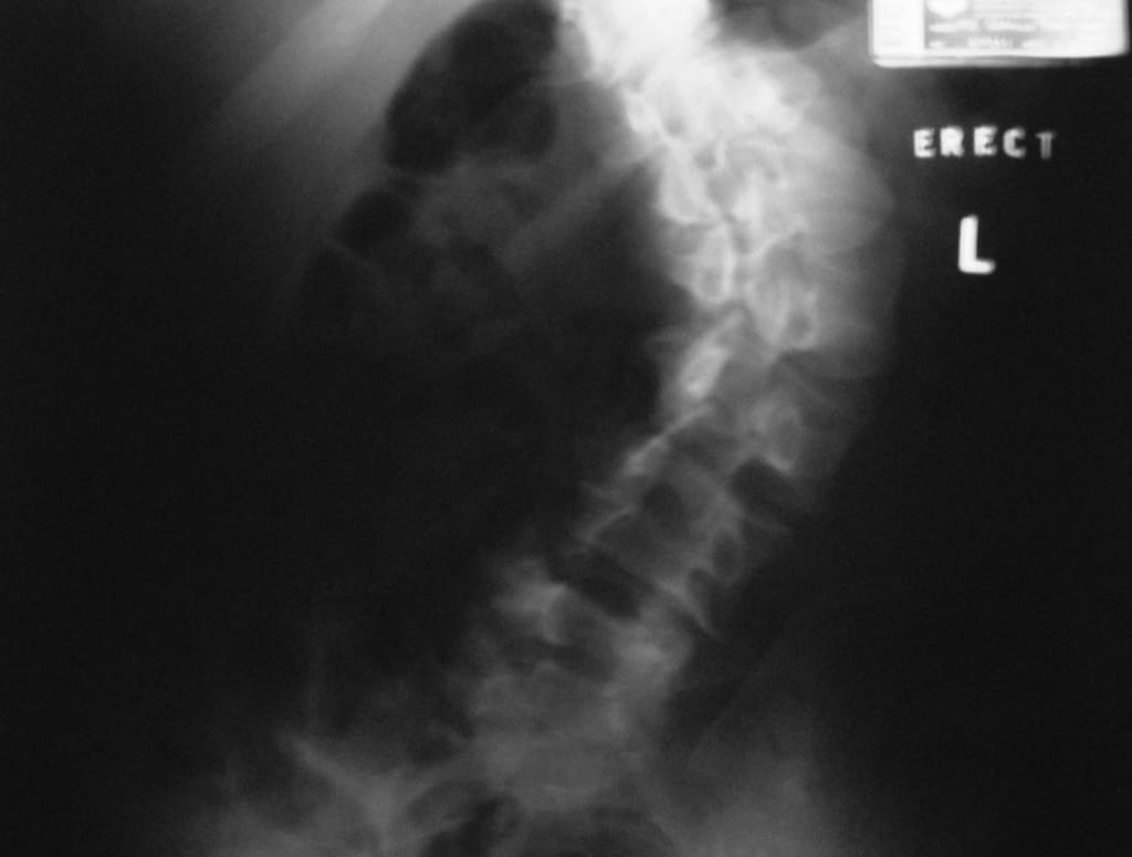 curvedspine scoliosis ray